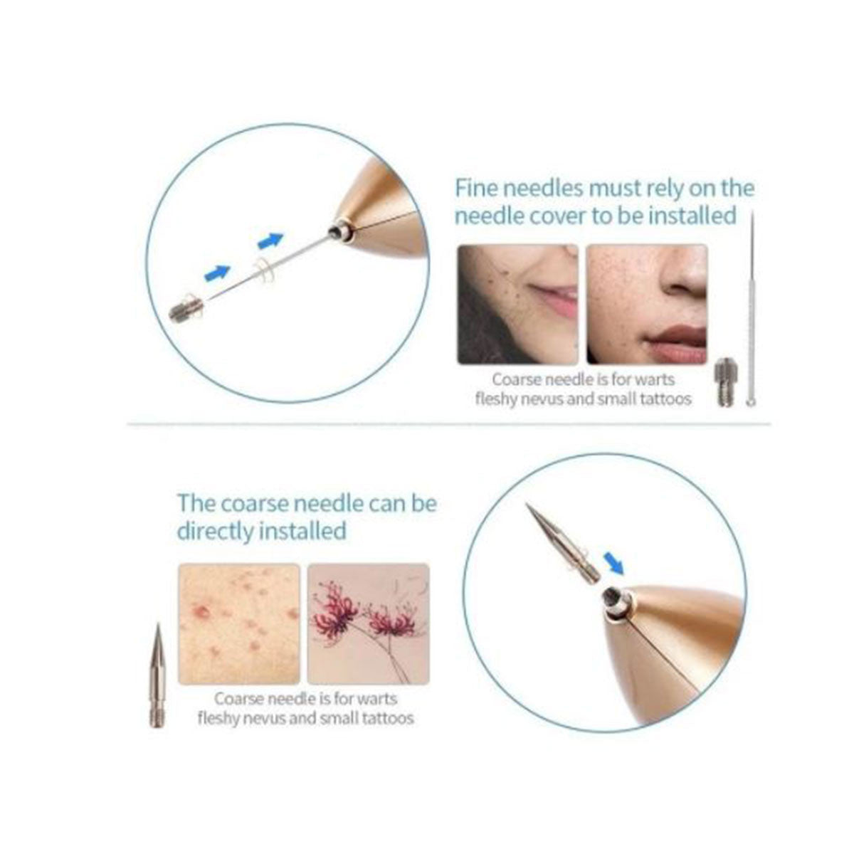 Cauterizador Recargable Quita Verrugas